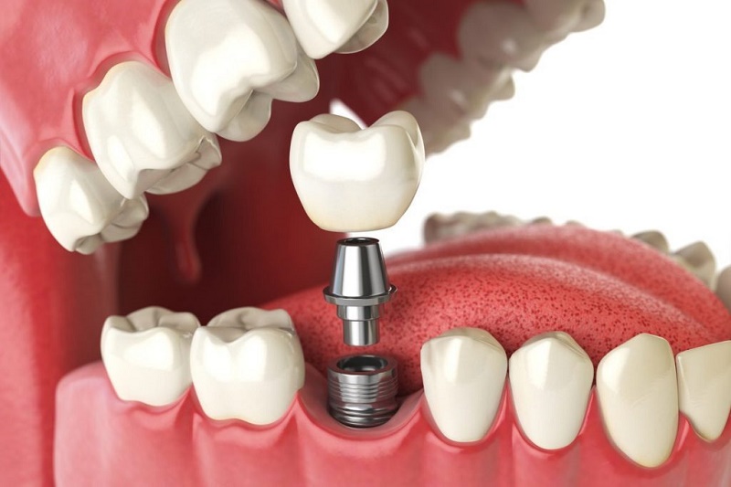 Những tác hại của việc trồng răng implant