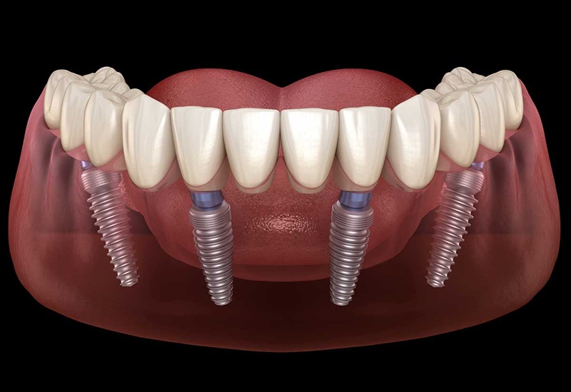 Có những lưu ý gì khi trồng răng implant all on 4