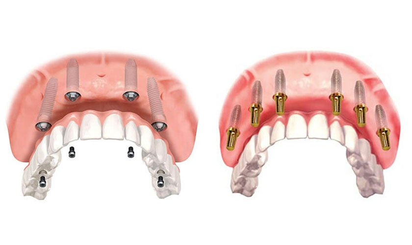 Những nhược điểm trồng răng Implant là gì?