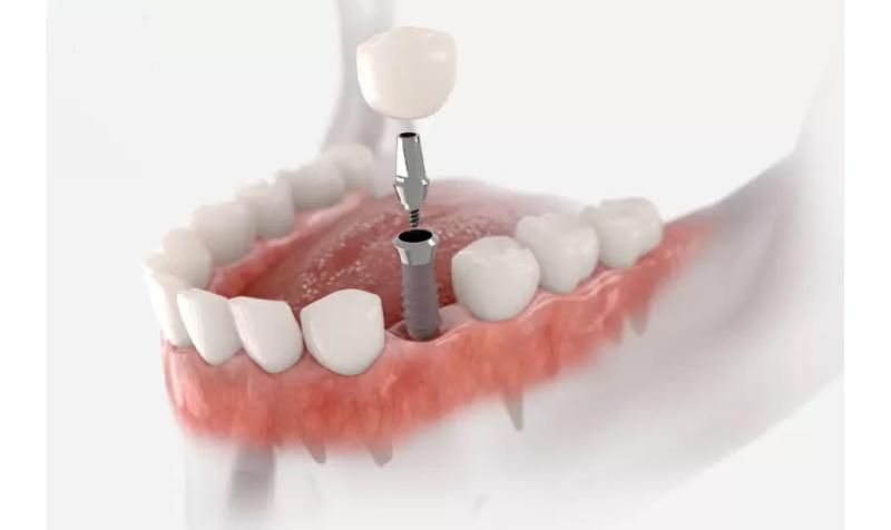 Những tiêu chí lựa chọn trụ implant tốt