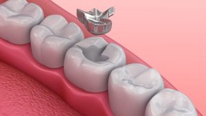 Những điều cần biết khi trám răng sai kỹ thuật có hại gì?