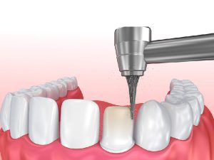 Có nên mài răng bọc sứ hay không? mài răng bọc sứ là gì?