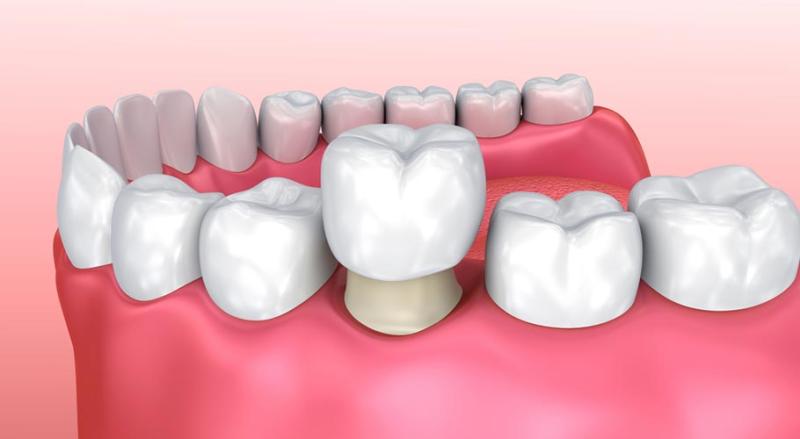 Có nên bọc răng sứ hay không? và bọc răng sứ có bền không?