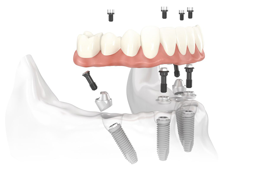 Một vài quy trình trồng răng implant all on 4