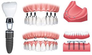 Có những lưu ý gì khi trồng răng implant all on 4