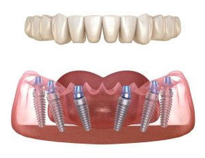 Việc trồng răng Implant có những nhược điểm gì?
