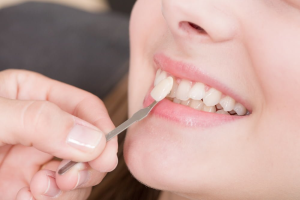 Các dấu hiệu nhận biết răng sứ cần làm lại bạn nên biết