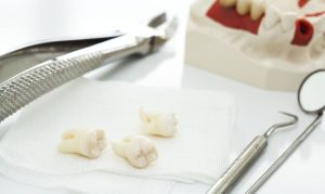 Việc nhổ răng khôn bao lâu thì lành? Cách chăm sóc khi nhổ răng khôn