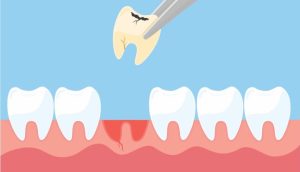 Có nên nhổ răng sâu hay không? những vấn đề liên quan đến răng sâu