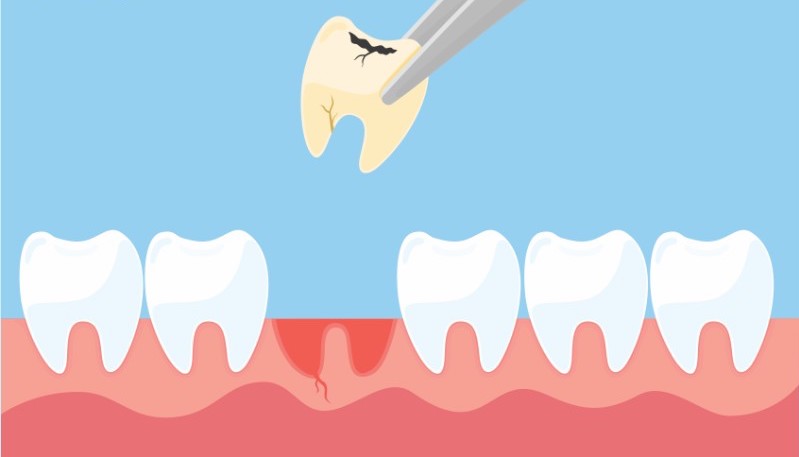 Có nên nhổ răng sâu hay không? những vấn đề liên quan đến răng sâu