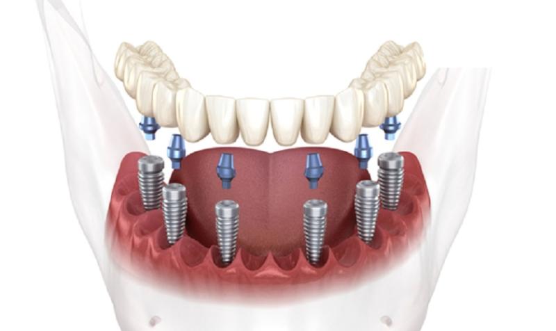 Một vài quy trình trồng răng implant all on 4