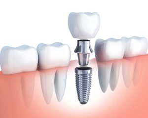 Những tiêu chí lựa chọn trụ implant tốt giúp bạn có hàm răng đẹp