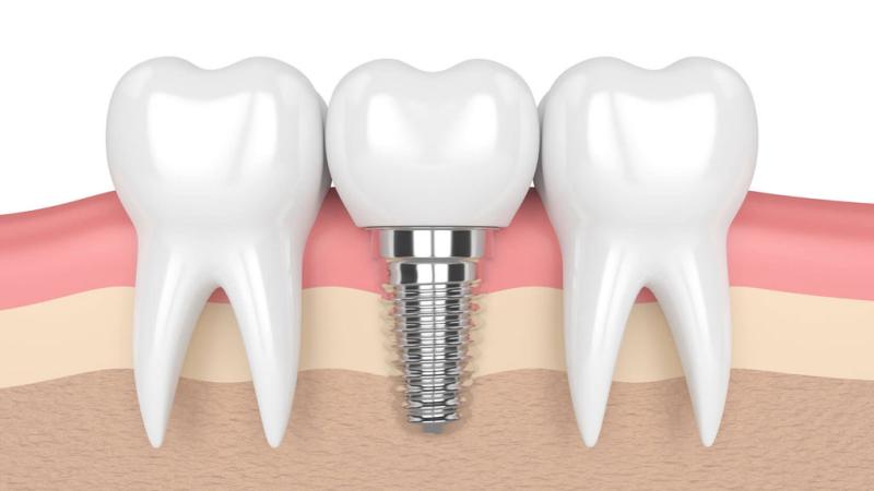 Những tiêu chí lựa chọn trụ implant tốt giúp bạn có hàm răng đẹp