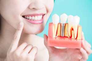 Những tác hại của việc trồng răng implant