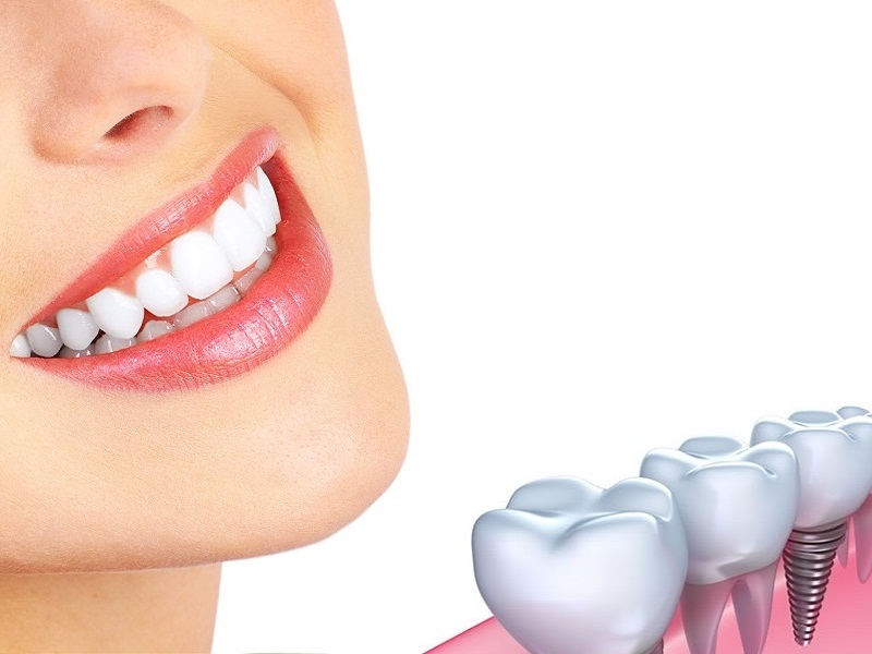 Những tiêu chí lựa chọn trụ implant tốt giúp bạn có hàm răng đẹp