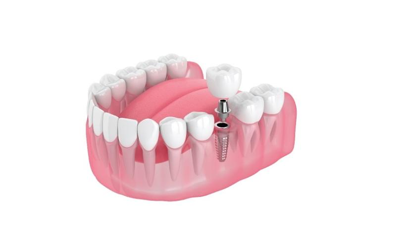 Những tác hại của việc trồng răng implant