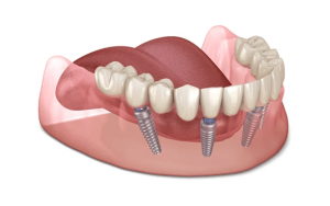 Trồng răng implant giá bao nhiêu? Cập nhật chi phí trồng răng implant