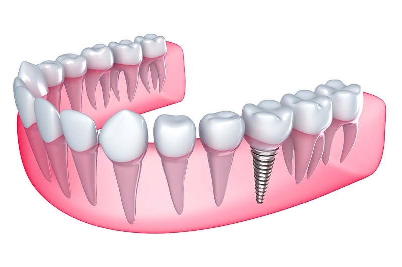 Trồng răng implant giá bao nhiêu? Cập nhật chi phí trồng răng implant