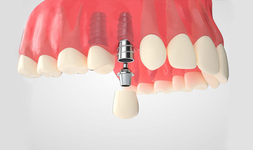 Quy trình trồng răng implant mất bao lâu?