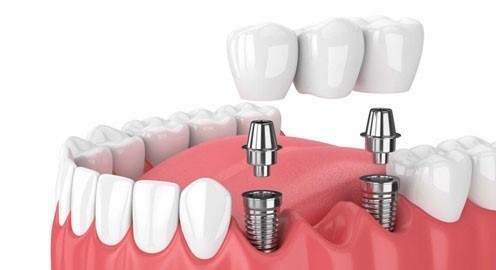 Quy trình trồng răng implant mất bao lâu?