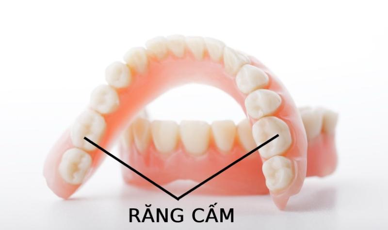 Nhổ răng cấm bao nhiêu tiền? quy trình nhổ răng cấm