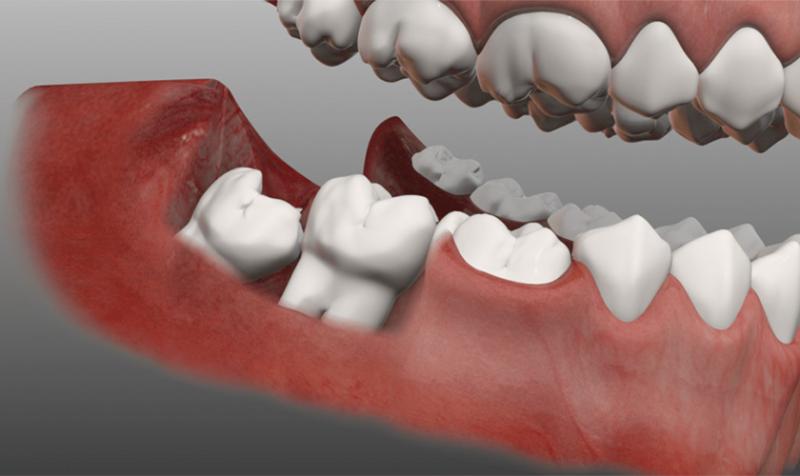 Các biến chứng nhổ răng khôn hàm dưới bạn có biết