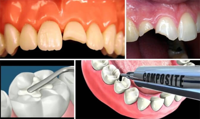 Trám răng composite là gì? Lợi ích khi trám răng composite