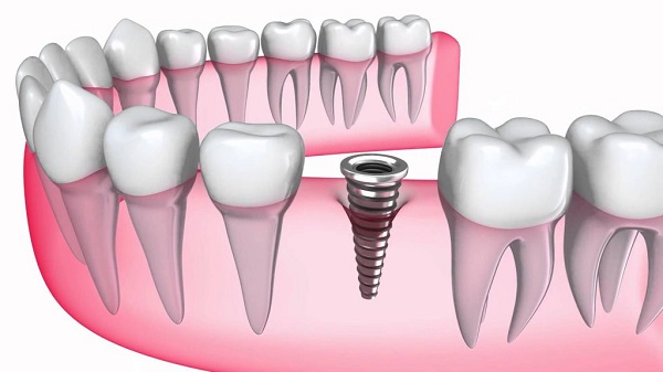 Quy trình trồng răng implant mất bao lâu?