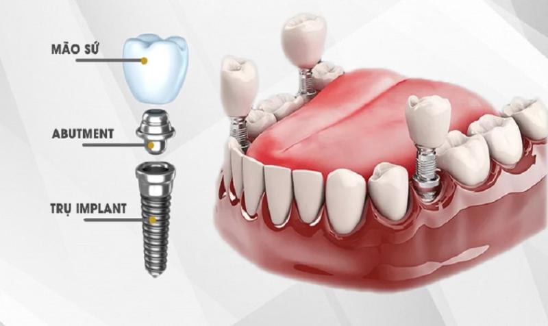 Trồng răng implant giá bao nhiêu? Cập nhật chi phí trồng răng implant