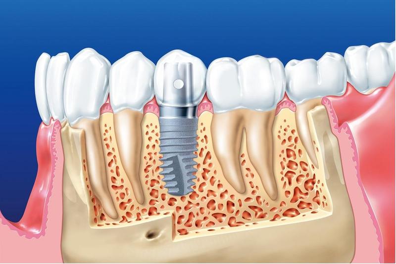 Quy trình trồng răng implant mất bao lâu?