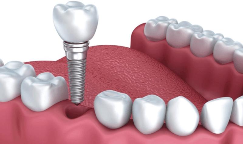 Trồng răng implant giá bao nhiêu? Cập nhật chi phí trồng răng implant