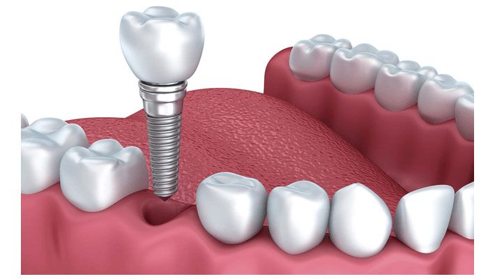 Quy trình trồng răng implant mất bao lâu?