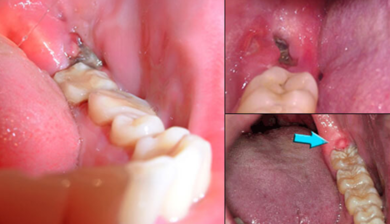 Các biến chứng nhổ răng khôn hàm dưới bạn có biết