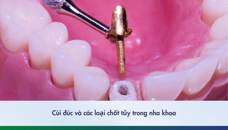 Cùi đúc là gì? tìm hiểu về cùi đúc khi làm lại răng