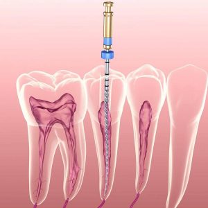 Thông thường răng lấy tủy có tồn tại được hết đời không?