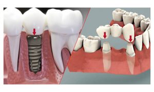 Trồng răng sứ vĩnh viễn: Quy trình lợi ích và những điều cần biết