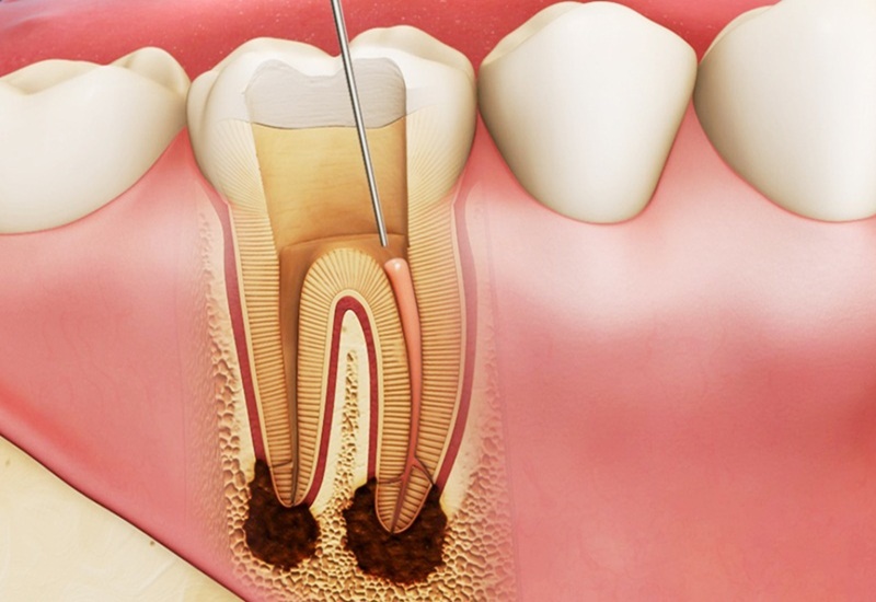 Những nguyên nhân dẫn đến viêm tủy răng