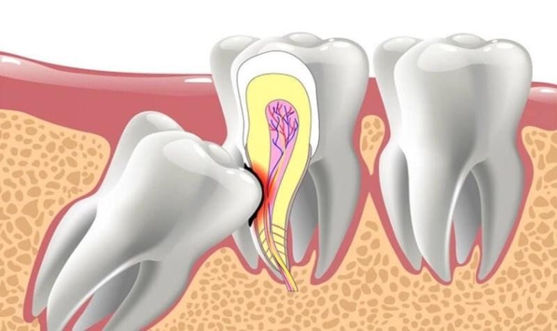 Khi bị đau răng khôn uống thuốc gì? Các cách khắc phục đau răng khôn tại nhà