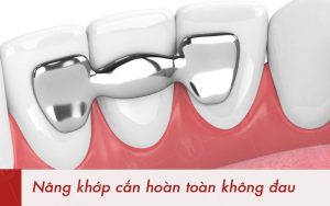 Những lý do nên nâng khớp cắn khi làm răng