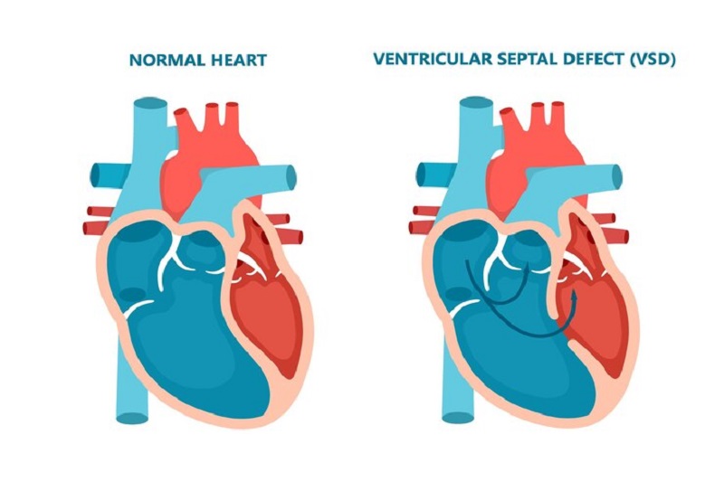 Sự tồn tại của lỗ thông trong bệnh thông liên thất