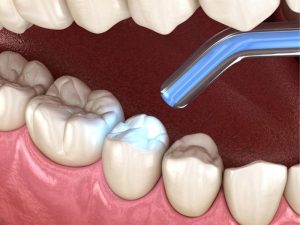 Miếng chống nghiến răng là gì? Cách sử dụng miếng chống nghiến răng