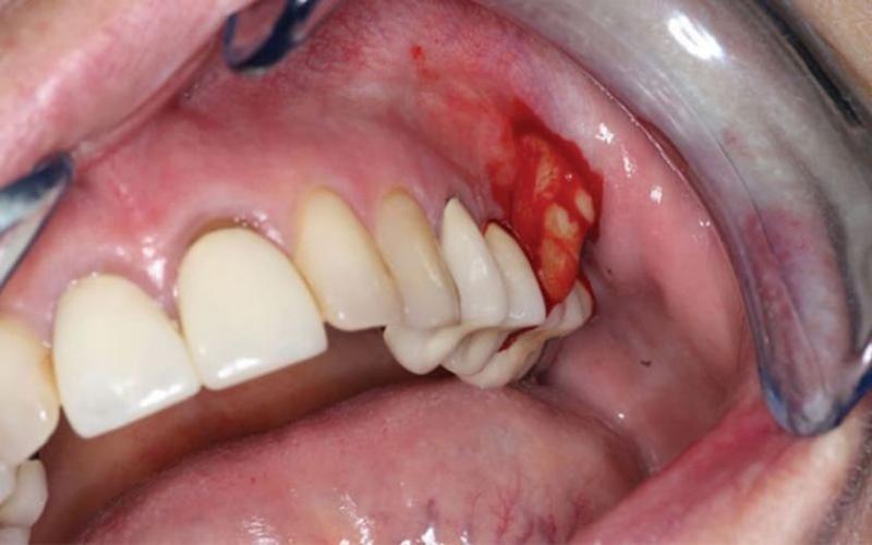 Như thế nào là áp xe răng? Áp xe răng có ảnh hưởng gì không?