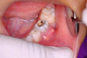 Như thế nào là áp xe răng? Áp xe răng có ảnh hưởng gì không?