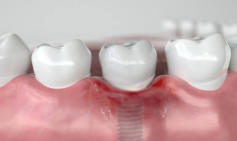 Cập nhật bảng giá trồng răng sứ vĩnh viễn