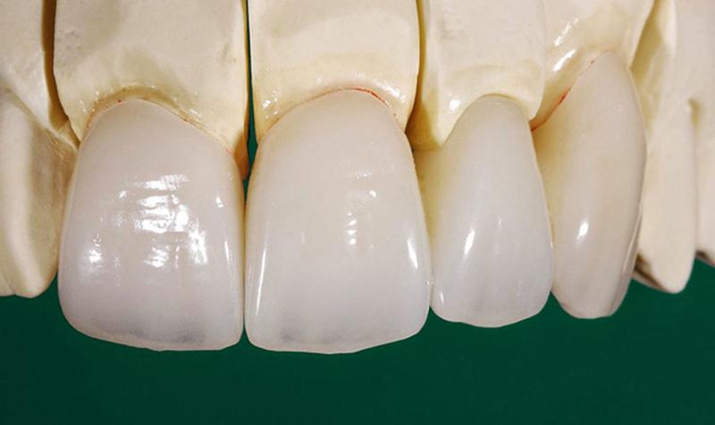 Làm răng sứ Zirconia giá bao nhiêu? Bảng giá làm răng tại Park Way