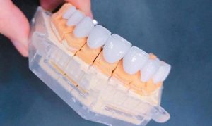 Làm răng sứ Zirconia giá bao nhiêu? Bảng giá làm răng tại Park Way