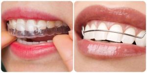 Hàm duy trì là như thế nào? Tại sao phải cần làm hàm duy trì?
