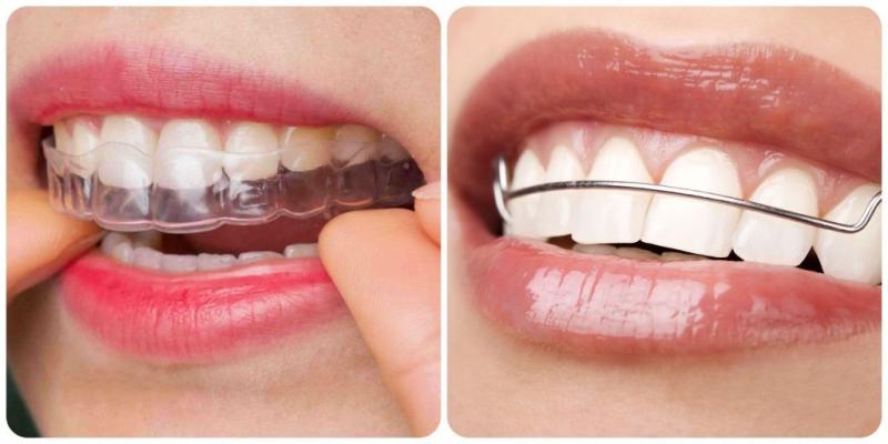 Hàm duy trì là như thế nào? Tại sao phải cần làm hàm duy trì?