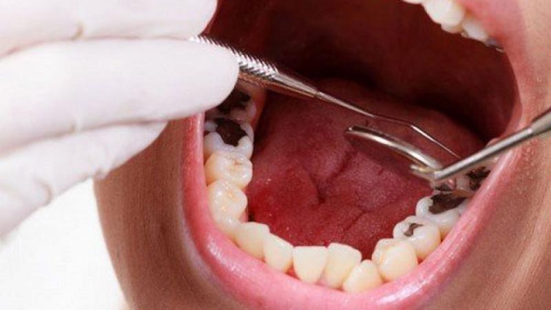 Thường nhổ răng sâu bao nhiêu tiền? Tất cả những thông tin bạn cần biết