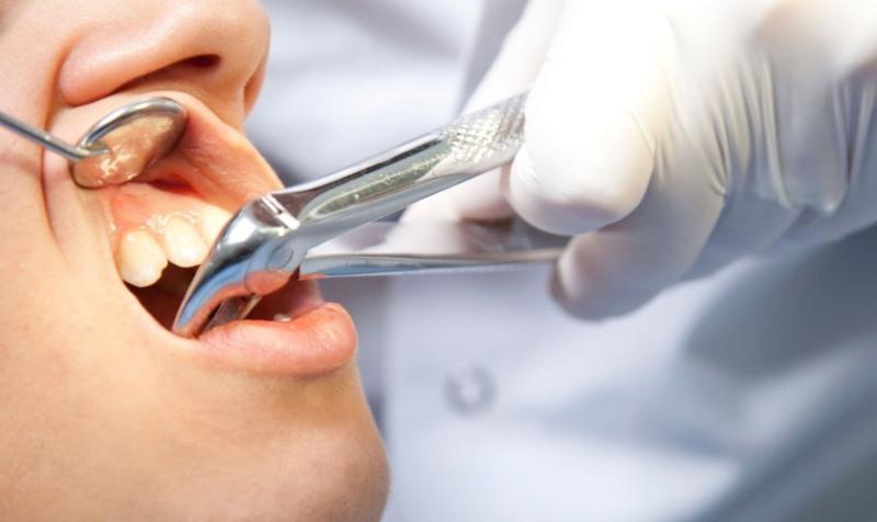 Những lưu ý khi nhổ răng kiêng ăn gì? Chăm sóc răng miệng sau khi nhổ răng